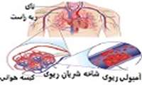 آمبولی ريه / علائم، پيشگيری، درمان