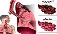 بيماری آمفيزم / تعريف، علائم، درمان